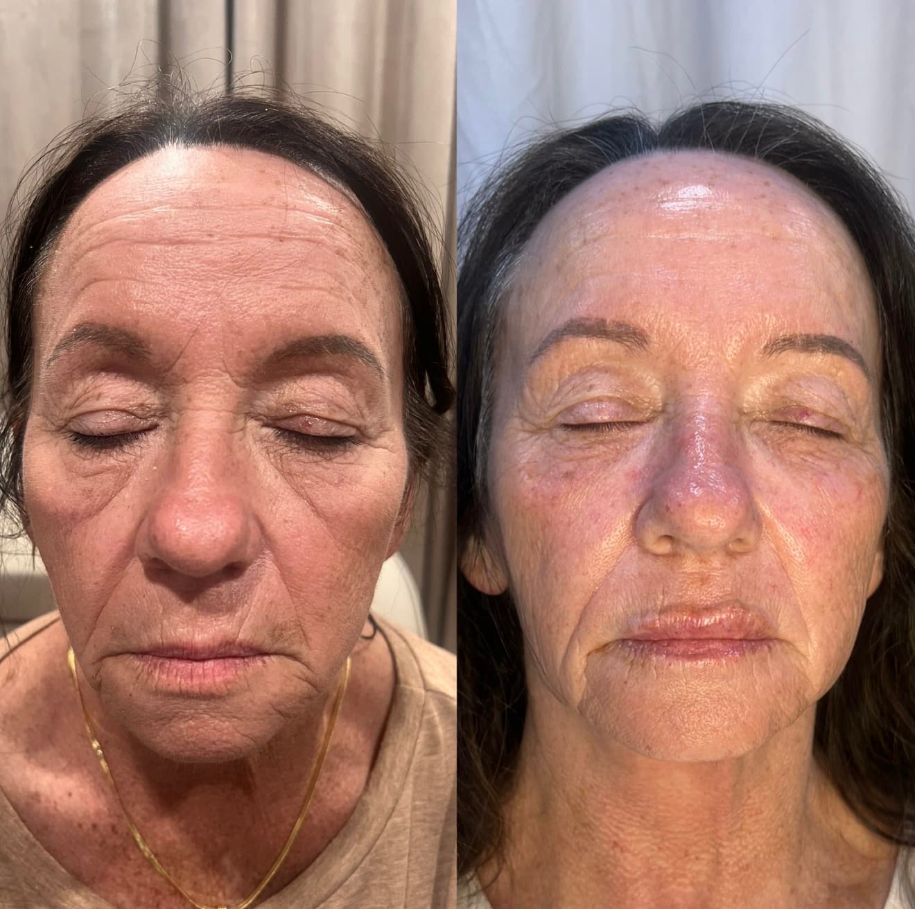 Biostimulators before and after