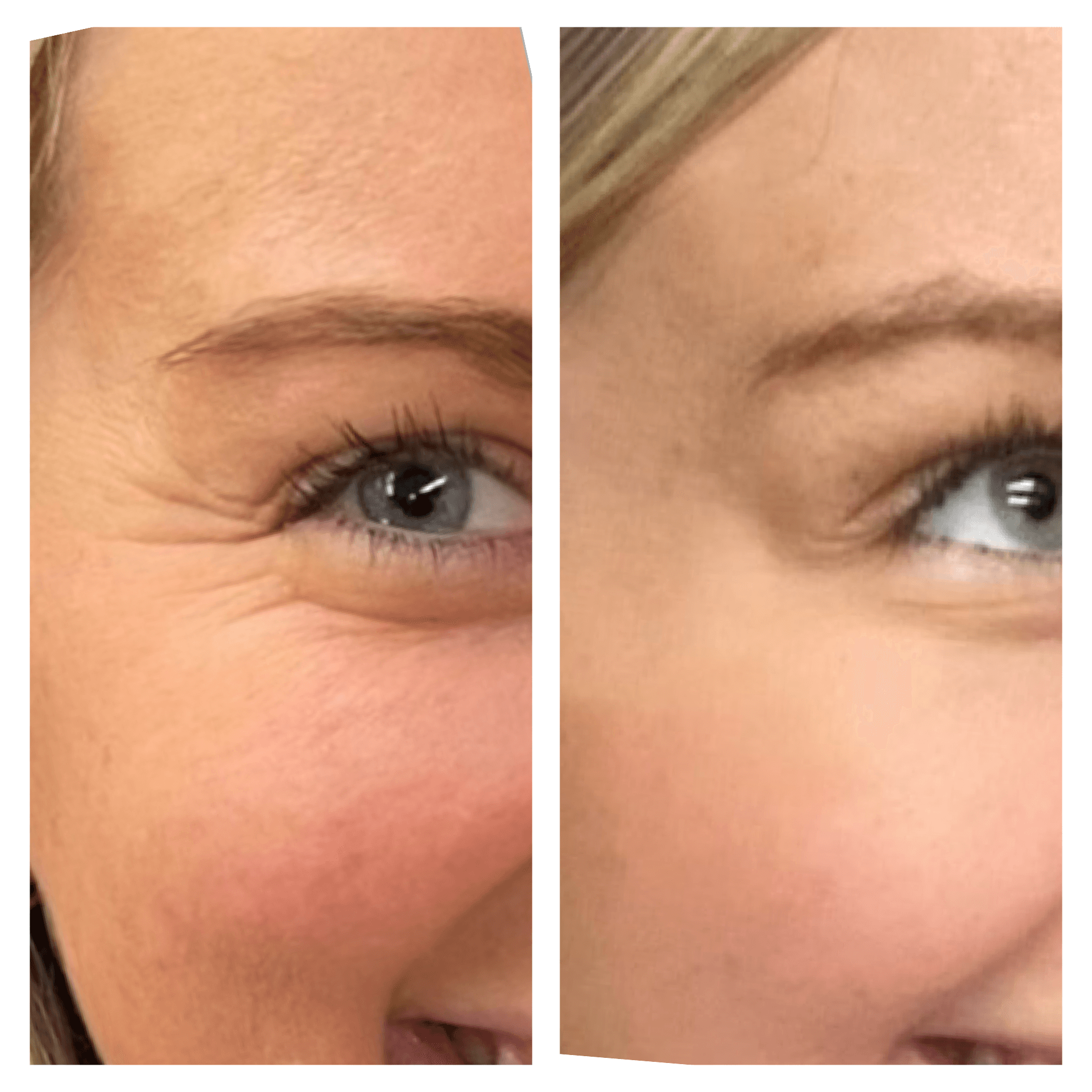 Botox before and after