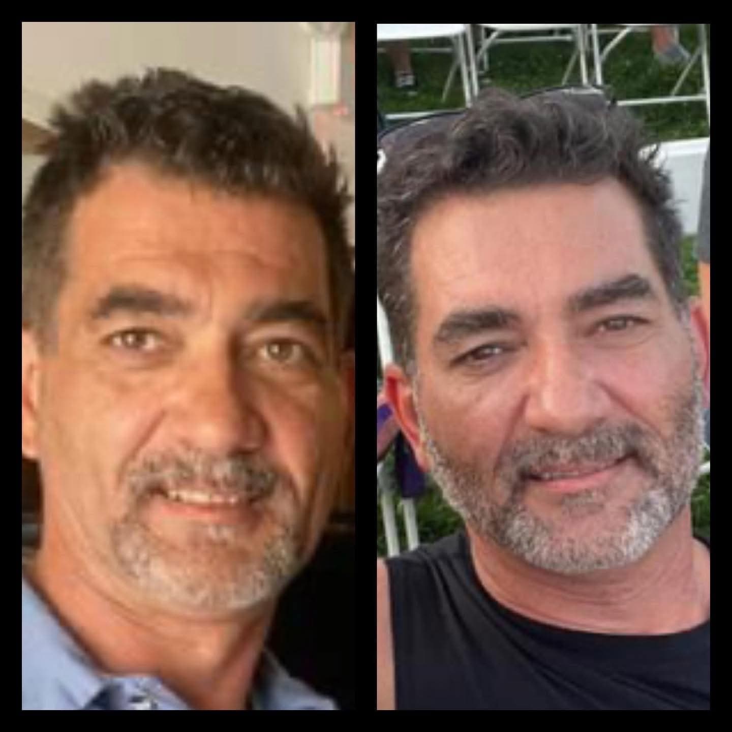 Facial Filler before and after